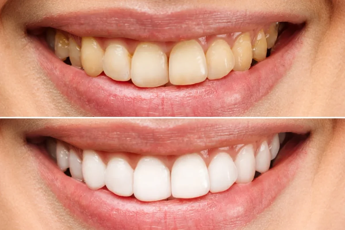 Albire dentară Onsmile Iași