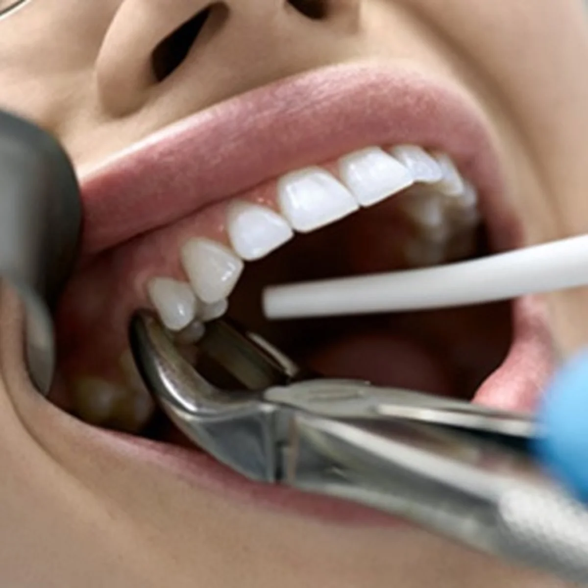 Chirurgie dento-alveolară Onsmile Iași