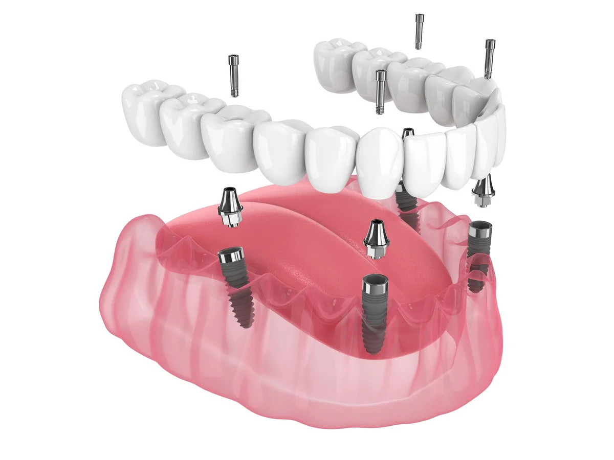 Implanturi dentare Straumann Onsmile Iași